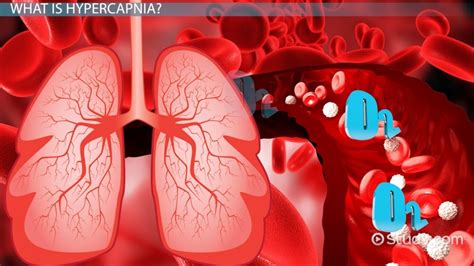 Hypercapnia: Definition, Symptoms & Treatment - Lesson | Study.com