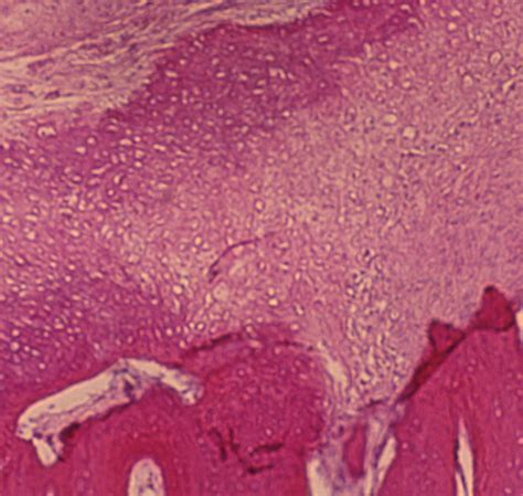 Histology Of Osteosarcoma