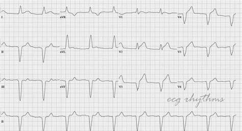 ECG Rhythms: MI in Paced Rhythm