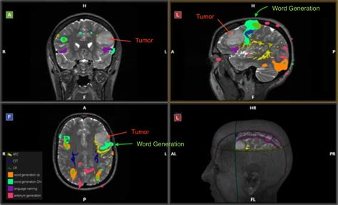 Cureus | Reconciling Functional MRI Findings With Intraoperative ...