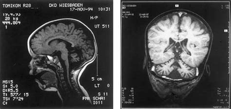 MRI of patient 1 at 17 months of age displaying symmetrical cerebellar ...