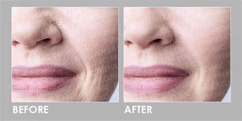 Profhilo : Bioremodelling Anti-aging - Premier Clinic