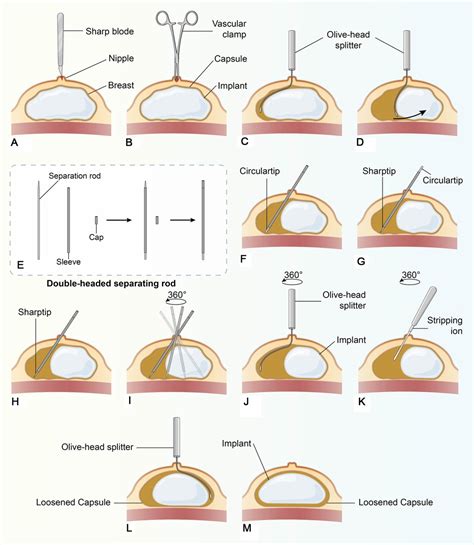 Frontiers | Case Report: Improved surgical treatment for breast ...