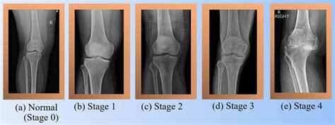 Osteoarthritis Stages Knee