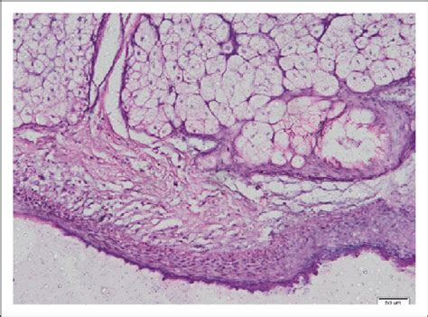 Left ovarian cyst. Histopathology aspect in HE coloration sugestive for ...