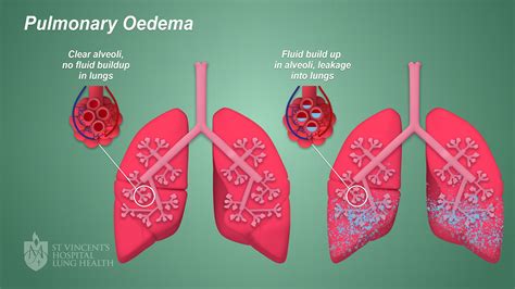 Pulmonary Edema Memes