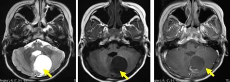 Pilocytic astrocytoma – Radiology Cases