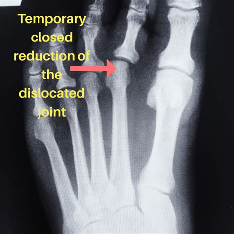 Plantar Plate Injury | Final Kick Ankle and Foot Clinic Ankle and Foot ...