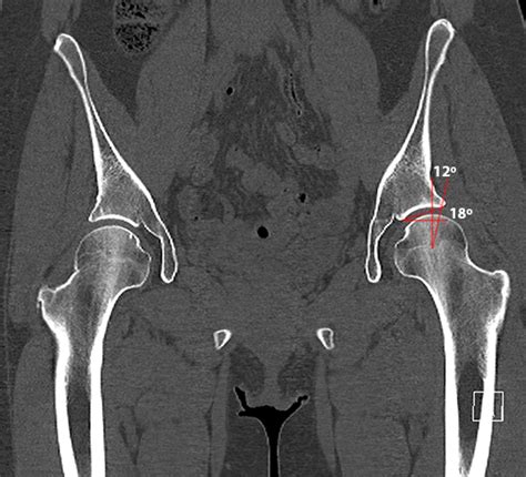 Developmental Dysplasia of the Hip - Radsource