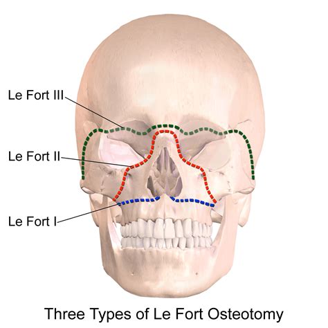 emDOCs.net – Emergency Medicine EducationLe Fort Fractures - emDOCs.net ...