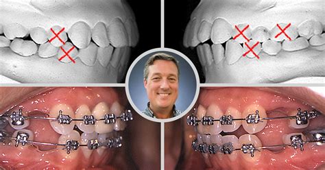 Dr. Shockley Wier's 3-Step Guide to Improve Your Orthodontic Extraction ...