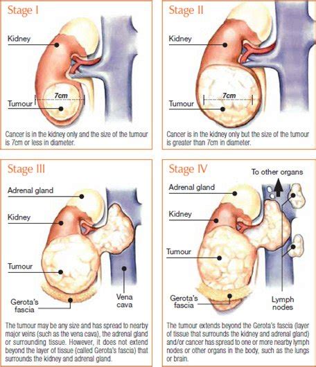 ¿El tamaño de un tumor determina la etapa?? - startupassembly.co