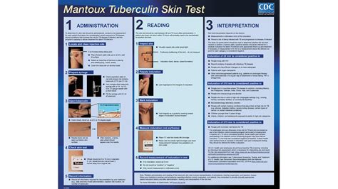 Mantoux Tuberculin Skin Test Toolkit | Tuberculosis (TB) | CDC