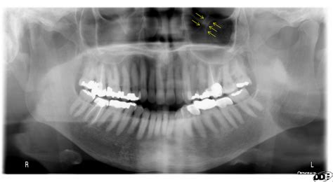 infraorbital canal – Dr. G's Toothpix