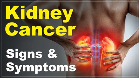 Signs and Symptoms of Kidney Cancer by Cancerclinix - YouTube