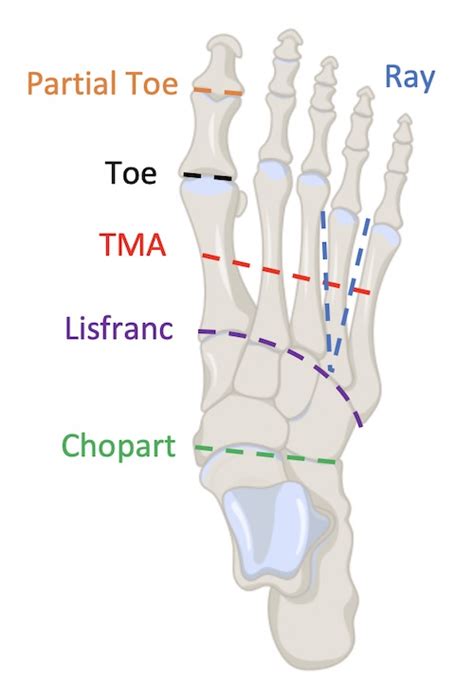 Amputation - The Operative Review Of Surgery