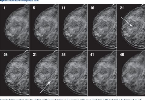 [PDF] Fundamentals of Breast Tomosynthesis Improving the Performance of ...