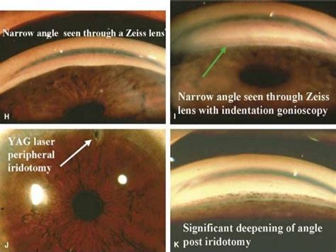 Gonioscopy presentation