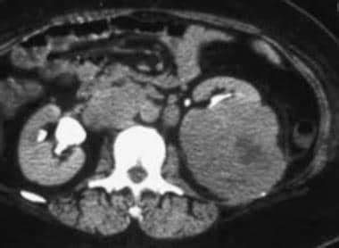 Renal Cell Carcinoma Imaging: Practice Essentials, Radiography ...