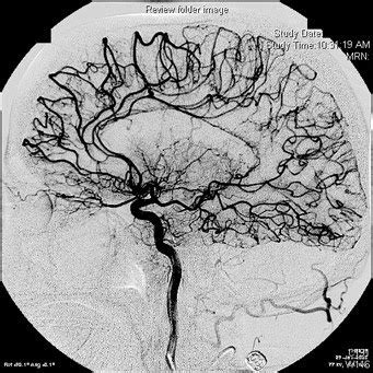 Megan's CT/MRI Pathology: Moyamoya Disease