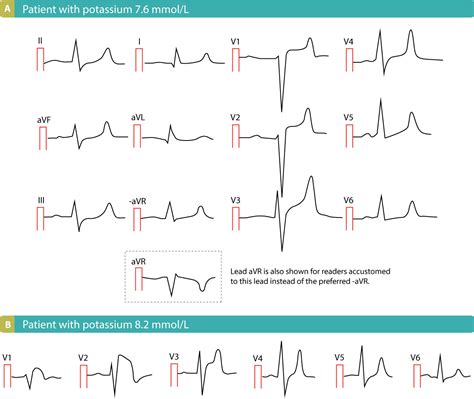 St Segment Elevation Ecg