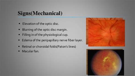 Papilledema Signs