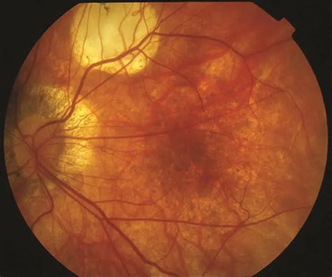 Myopic macular degeneration - American Academy of Ophthalmology