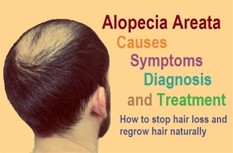 What Is Alopecia Hair Loss / Alopecia Areata A Comprehensive Review Of ...