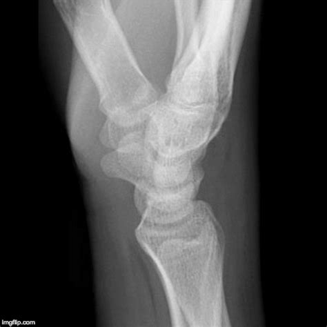 EMRad: Radiologic Approach to the Traumatic Wrist