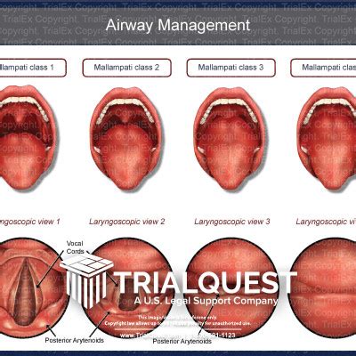 Airway Management - TrialExhibits Inc.