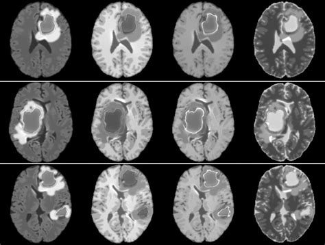 Simulated MRI images (FLAIR, T1, T1-Gd and T2) of tumors with different ...