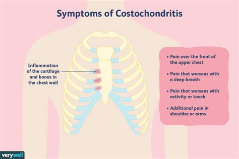 Wat is costochondritis? - Med NL