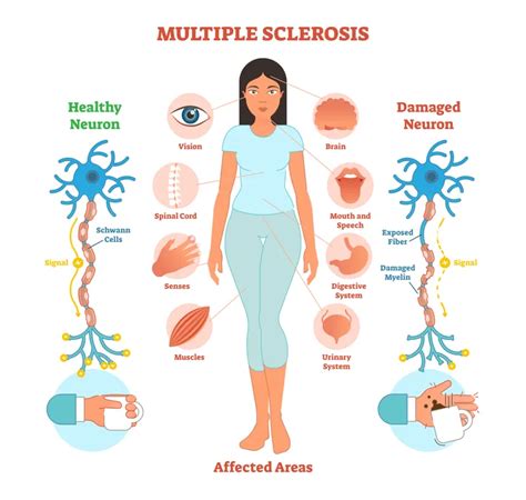 12 Signs and Symptoms of Multiple Sclerosis in Women – ActiveBeat ...