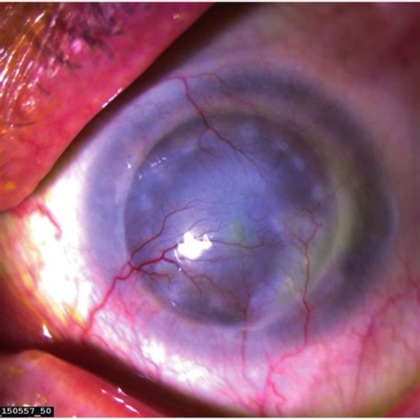 Corneal neovascularization in pathological situations. Recurrent ...