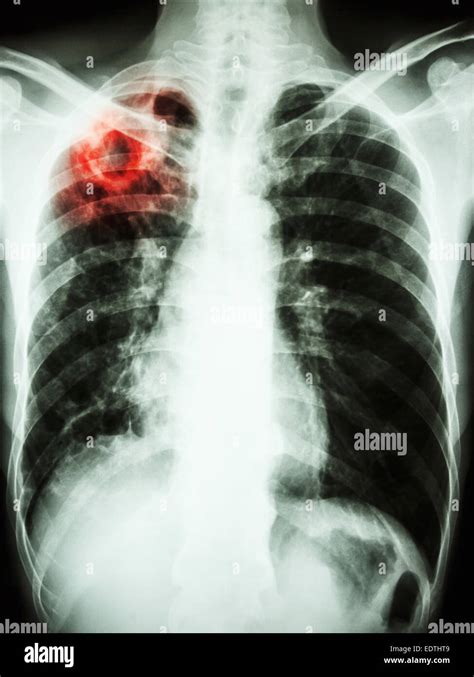 Pulmonary Tuberculosis Tb Chest Xray Show Stock Photo | The Best Porn ...