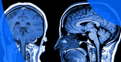 How to Read MRI Results: Interpreting Your Report & Terminology