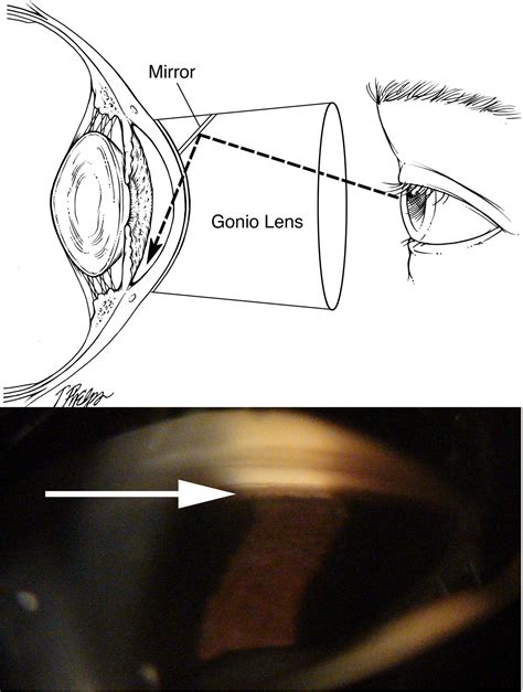 Gonioscopy Narrow Angle