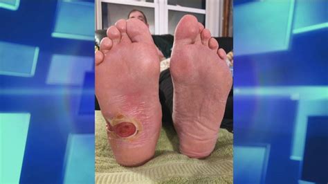 Scientists map skin cells that contribute to diabetic foot ulcers ...