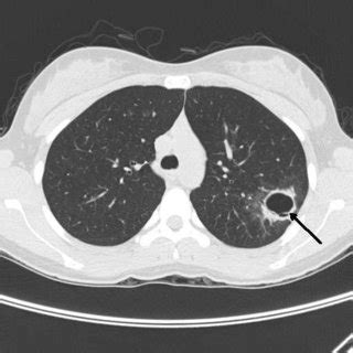 After transecting the ascending aorta, inspection of the aortic valve ...