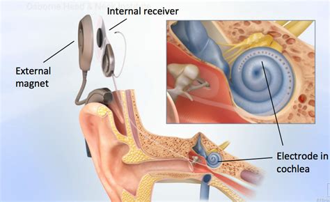 Cochlear Implant Device Los Angeles, CA