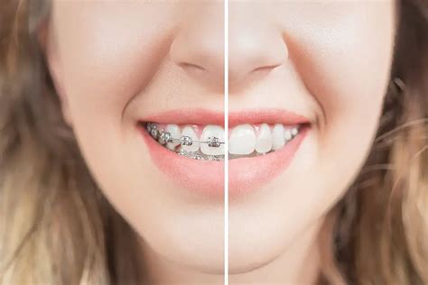 🥇 What to do if Your Teeth Are Shifting After Braces?【 2021 】Tips