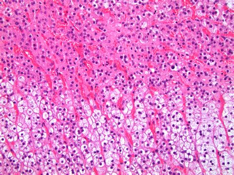 Pathology Outlines Histologyadrenal Cortex