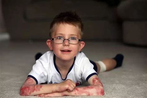 Little boy's 'butterfly' condition causes skin to blister and eyeballs ...