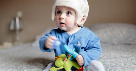 Brachycephaly Treatment & Plagiocephaly Helmet | by David James | Medium