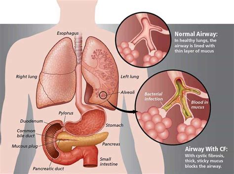 3-Ingredient Remedy That Clears Lung Mucus Immediately