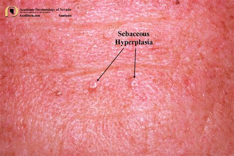 Sebaceous Hyperplasia Lips Treatment | Lipstutorial.org