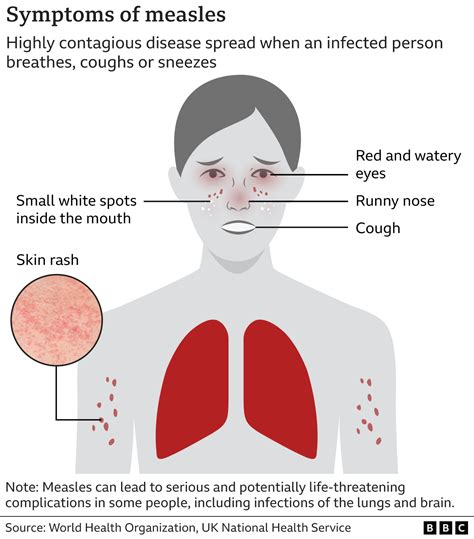 Measles: Cases in Northern Ireland 'only a matter of time' - BBC News