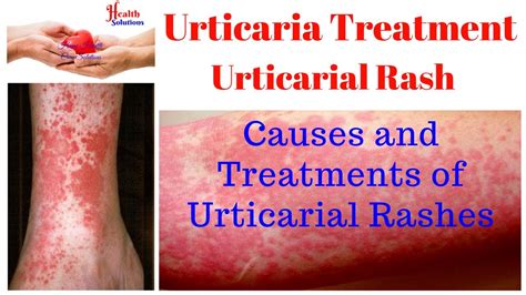 Urticaria Treatment - Urticarial Rash - Causes and Treatments of ...