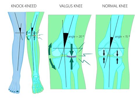 Distal Femoral Osteotomy | Valgus Knee Malalignment | Sugar Land ...