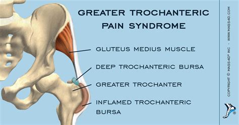 Trochanteric Bursitis And It Band Syndrome